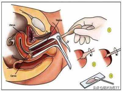 重庆代孕可以选择性别吗-广州哪个医院能代孕_关于宫颈癌筛查你需要了解的