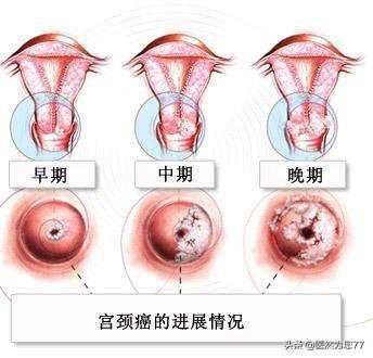 重庆代孕可以选择性别吗-广州哪个医院能代孕_关于宫颈癌筛查你需要了解的